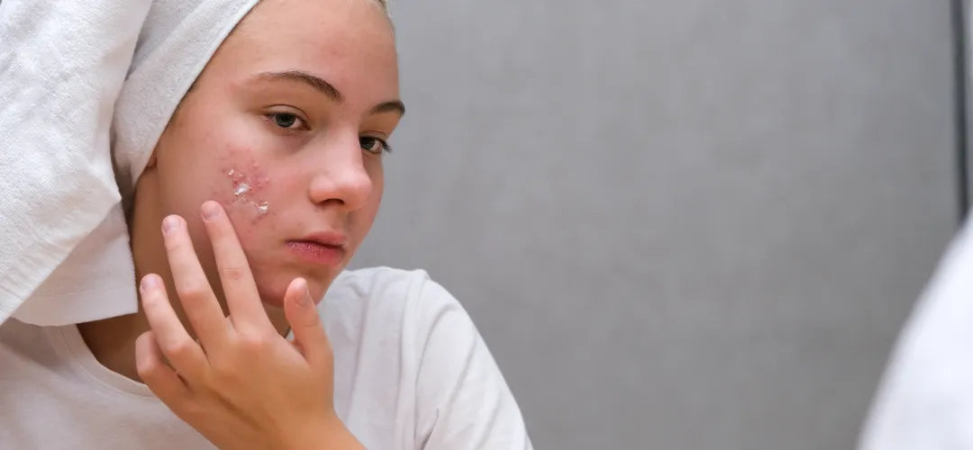 How to Treat Acne with Benzoyl Peroxide?